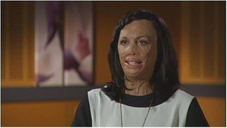 Turia Pitt Update | Can-Do Ability